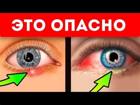 Признак болезней глаза