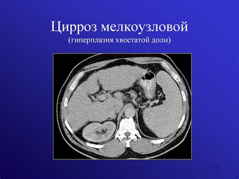 Компьютерная томография печени при гиповаскулярном очаге