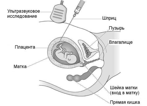 Причины гипоплазии ворсин хориона: