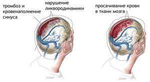 Симптомы неслияния синусов головного мозга